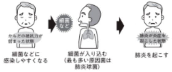 誤嚥性肺炎